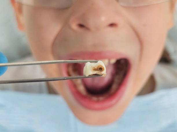 Best Emergency Tooth Extraction in Island Walk, FL